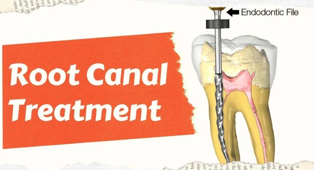 Root Canal Treatment (RCT)